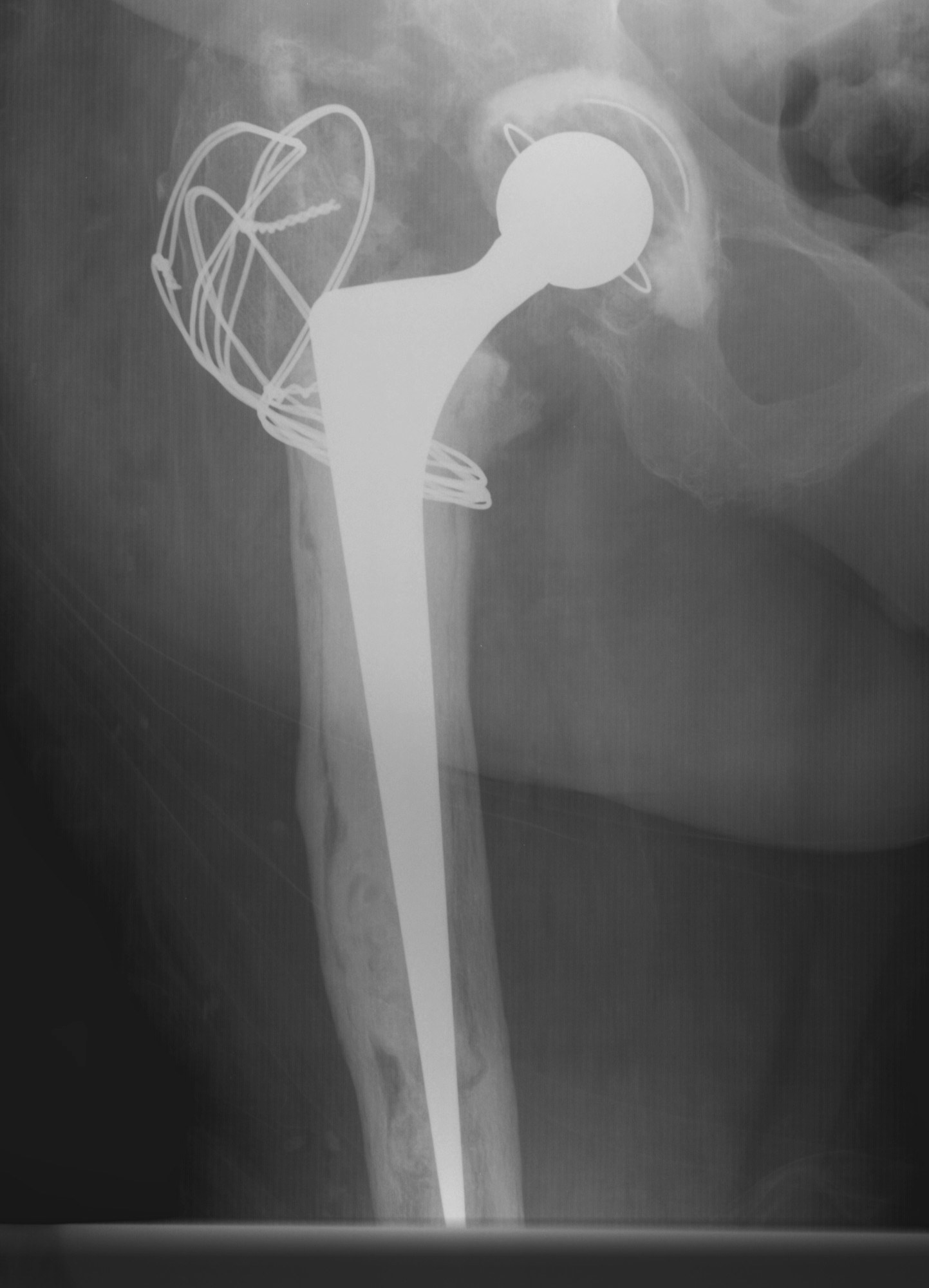 Revision Femur Long Stem Cemented Femoral Component